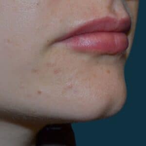 Lip Filler