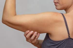 Close up of woman's arm with loose skin needing arm lift surgery in East Greenwich